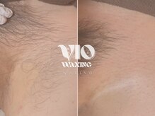 ヴィオワクシング(VIO WAXING)