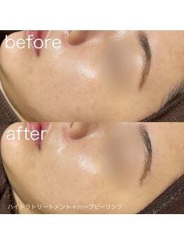 ルルラ リコ(lulula rico)/症例写真/ハーブピーリング