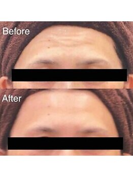 ブランシェ 金沢店 × 椿/シワ・たるみケア　お客様