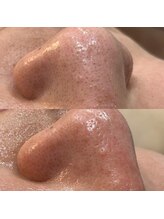 シャルム(CHARME)/毛穴洗浄(全顔)