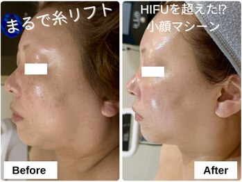 バイ リス(by LYS.)/たるみにアプローチ