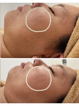 エン(O'en)/ハーブピーリング