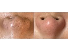 アストリア(ASTORIA)/小鼻の部分WAX