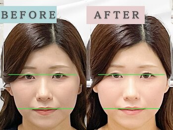 エルシンメトリー矯正院(ailesシンメトリー矯正院)/before＆after　ailes式小顔矯正