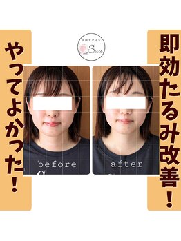 美顔デザインsuu.~若見えと歪み矯正専門の小顔サロン~/Before-After【30代】1回