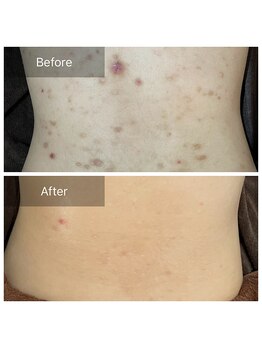 ビビ(VIVI)/腰のニキビに◎