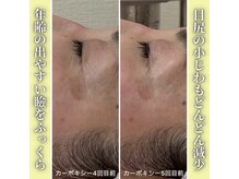 ハニエル(Haniel)/カーボキシー症例