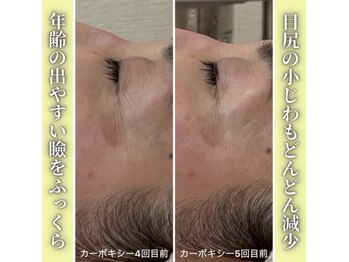 ハニエル(Haniel)/カーボキシー症例