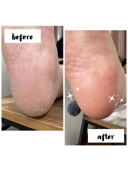 オーヴァル(Oval)/足裏全体の角質ケア