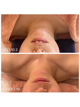 アティレ オオサカ(Attirer Osaka)/リフトアップ/小顔/美白/ツヤ