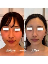 ティアラ(TIARA)/【小顔、たるみ】テラボーラー