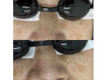 ホッコリ 府中店(HOKKORI)/BBLフェイシャル～頑固なシミに