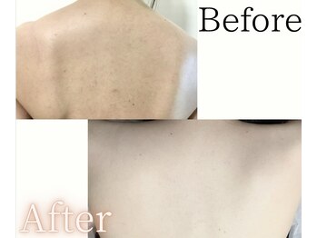 イーサム 高槻摂津富田店(e-sam)/ 背中脱毛