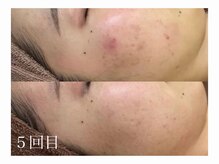 ホワイトアクア 加古川店(WHITE AQUA)/ハーブピーリングで肌荒れ改善