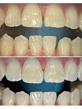 ベル(BEL)/クリスタルホワイトニング３回目