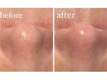 エムフルール 吹田市/毛穴洗浄before/after