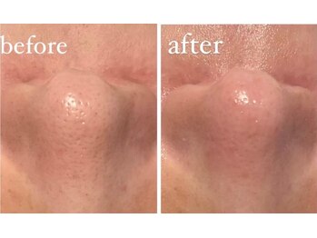 エムフルール 吹田市/毛穴洗浄before/after