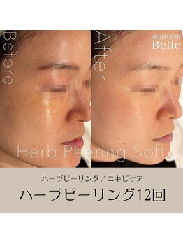 ベル 綱島(Belle)/ハーブピーリング【12回】