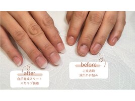 自爪育成　深爪矯正　長さ出し有