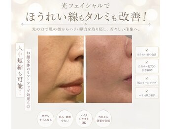 リベラサロン(LIBERA SALON)の写真/リフトアップしてスッキリ印象へ。ほうれい線、たるみも改善！1回でも効果実感出来ます◎