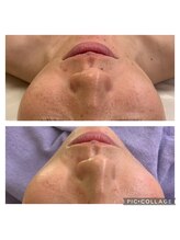 ルピナージュ(Lupinage)/【肌質改善】-ニキビケア-