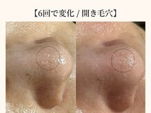 ドリームスパ 武蔵小杉店(DREAM SPA)/毛穴吸引＋引き締めパック＋導入