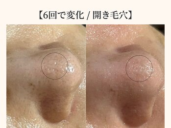 ドリームスパ 武蔵小杉店(DREAM SPA)/毛穴吸引＋引き締めパック＋導入