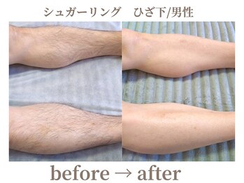 サロンラペーシュ(Lapeche)/シュガーリング befor→after