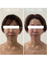 ポラス(Polus)/小顔コルギ