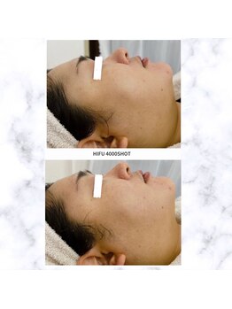 ルシェリア(Le cherien)/小顔リフトアップ