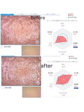 エクラ(eclat)/施術前後の驚きの変化♪