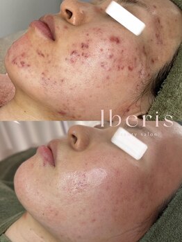 イベリス(Iberis)/ハーブピーリング/ニキビケア