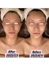 アユスリム(AYU SLIM)/短期集中ケア　　究極小顔♪