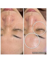 エステテックサロンラレーヌ 小山店(La Reine)/目元の小じわや額のしわにも◎