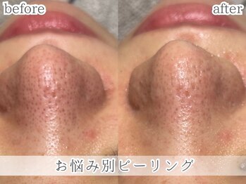 ミック(Mecc)/お悩み別ピーリング60分