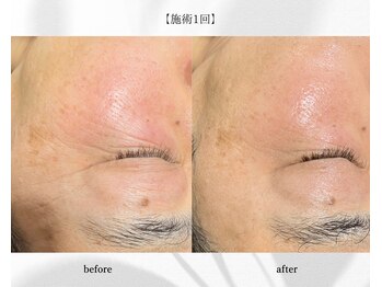 アン ビューティー(ann beauty)/施術1回【症例写真】