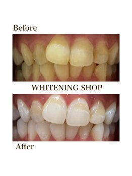 ホワイトニングショップ 安城店/【BeforeAfter】