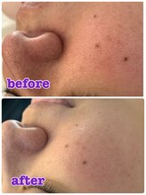 ミカ ネスト(Mika Nest)/ブラック光フェイシャル