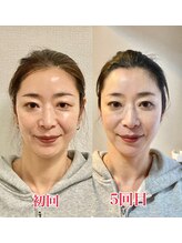 小顔22 ボルティ 赤坂支店(Bolty)/小顔シンメトリー矯正（5回）