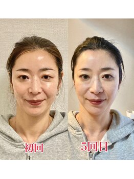 小顔22 ボルティ 赤坂支店(Bolty)/小顔シンメトリー矯正（5回）