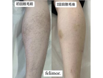 フェリモール(Felimor.)/メンズ光脱毛