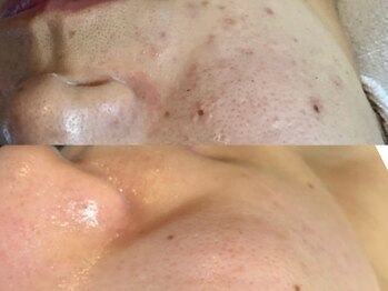 レアース(Lea's)/【光フォト】ビタミンC美容導入