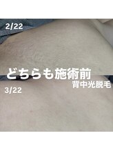 ブルーム 池袋西口店(Bloom)/背中光脱毛/全身光脱毛の効果