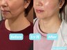 【鏡を見るのが嫌い…】本気のたるみ改善美容鍼12回コース/ 初回体験 /残1名
