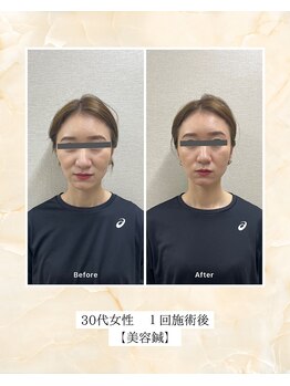 プレメ 人形町院(The Preme)/美容鍼　症例