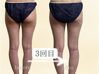 ヨサパーク リボーン(YOSA PARK Reborn)の写真/【美尻&太ももスキマ◎】年々落ちないお腹,腰回り,下半身太りを徹底的に解消★凸凹セル脂肪も浮腫みも撃退
