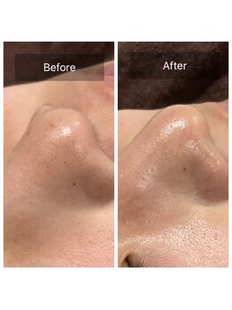 リュミエール デスポワール(Lumiere d'espoir)/毛穴洗浄