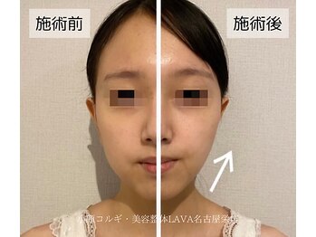 ラバ 名古屋栄店(LAVA)/小顔コルギ【面長】