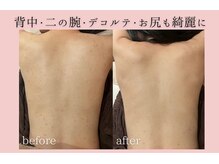 フォーウーマン(for woman)/背中ピーリング＋セルサー 