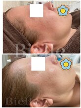 ビエル(Bielle)/昔からずっとある赤みが,1回で